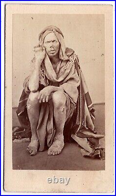 ANTIQUE CDV CIRCA 1860s MAN WITH LEPROSY SICK IN THE MIDDLE EAST RARE