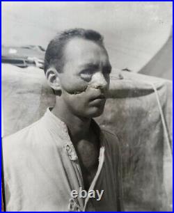 Antique photograph injured man early plastic surgery war hero medical US Army